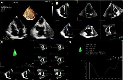 Decreased ventricular systolic function in chemotherapy-naive patients with acute myeloid leukemia: a three-dimensional speckle-tracking echocardiography study